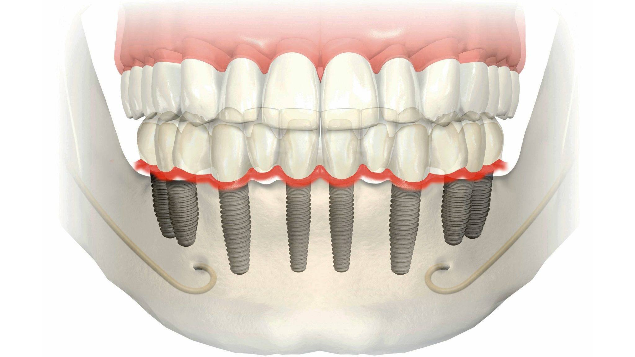 Как называется протезист. Метод базальной имплантации зубов. Имплантация на 8 имплантах. All on 4 (имплантация Osstem + временное протезирование). Базальная имплантация челюсти.